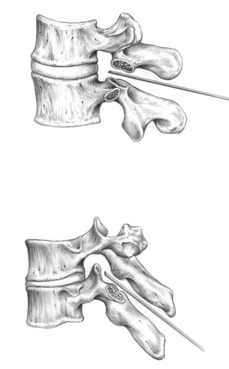 medial view of vertebra